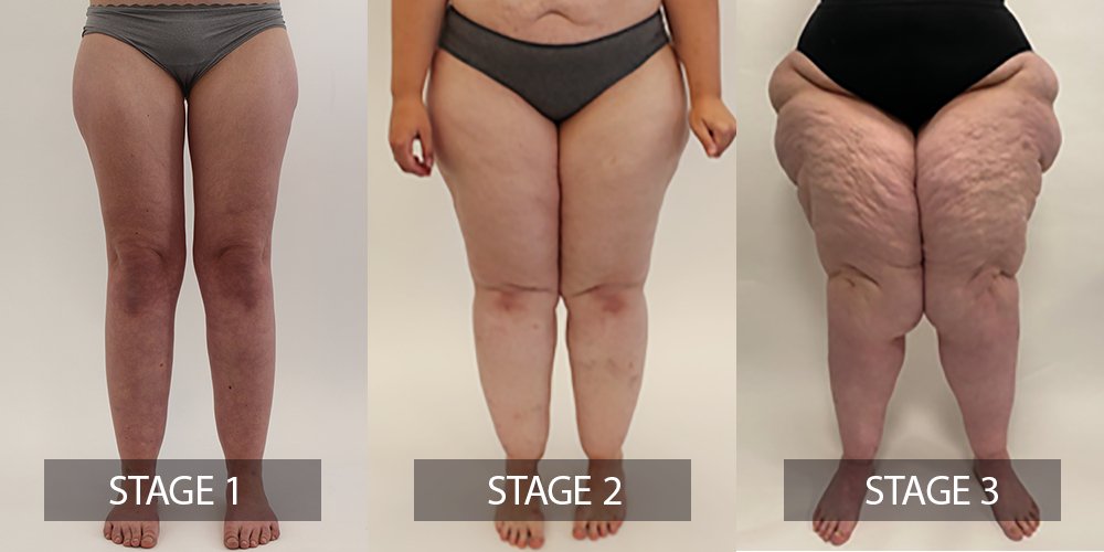 Stages and features of lipedema. (a) to (f): Front and back
