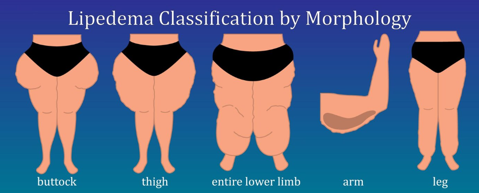 Lipedema : post-operative compression is an essential part of the